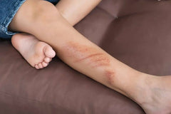 Cuts Scratches